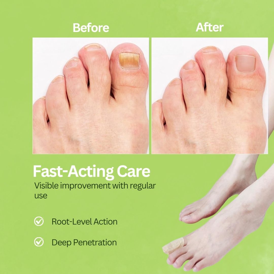 Fungal Nail Patches | FREE 30 Day Full Body Detox Guide eBook